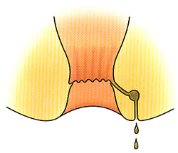 肛門周囲膿瘍・痔瘻